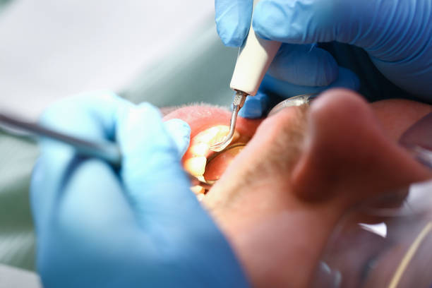 Best Emergency Dentist for Lost Fillings or Crowns in Brownlee Park, MI